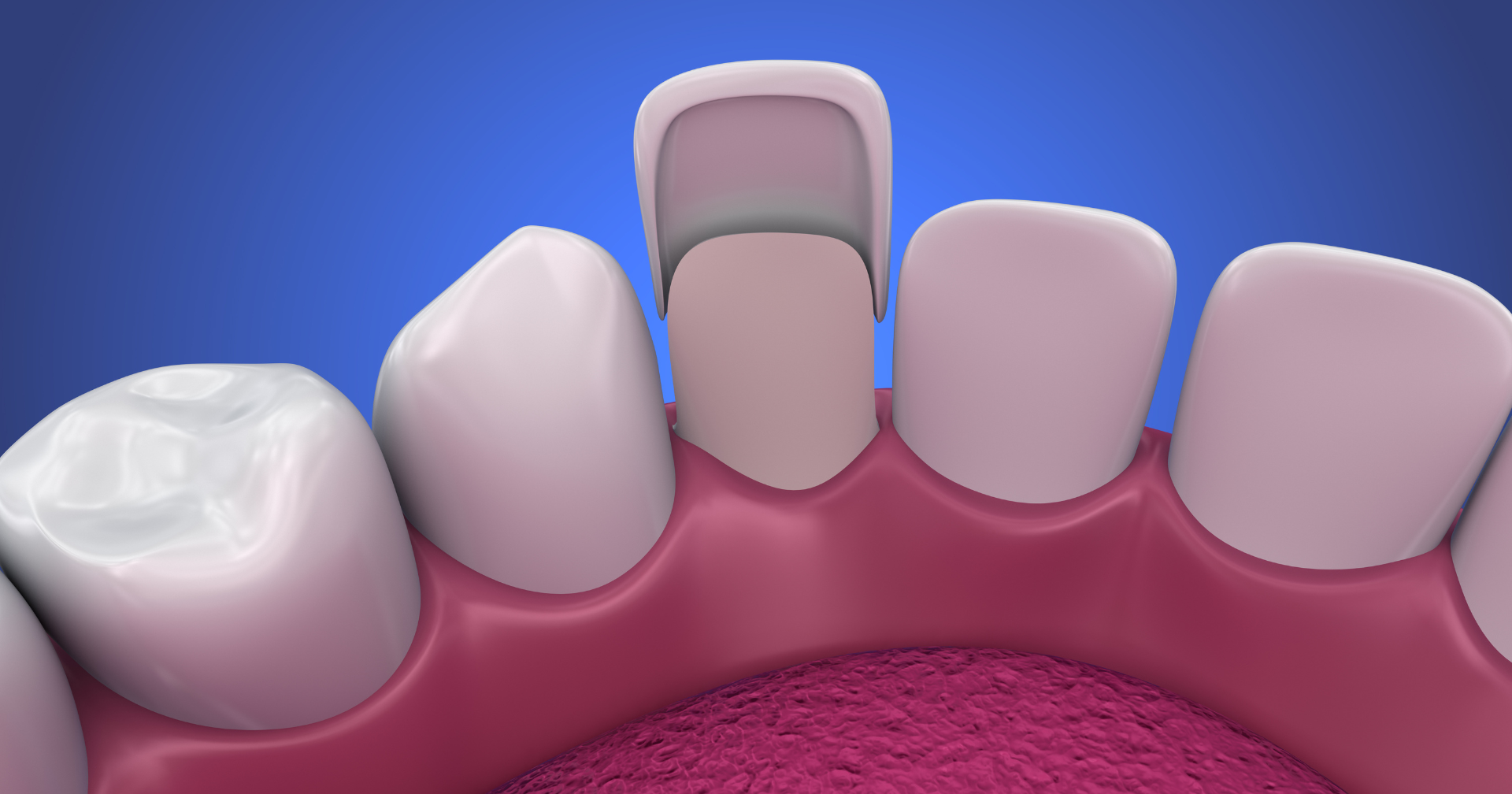 Veneers Bakersfield CA Riar Dental Arts Veneers Bakersfield CA Riar Dental Arts